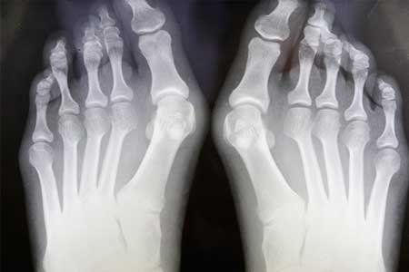 X-ray of feet