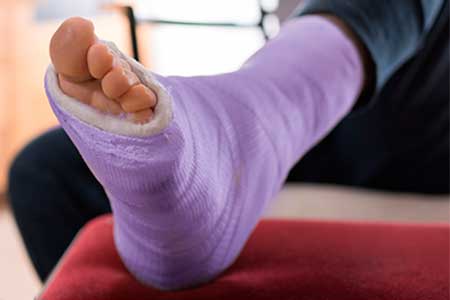 Foot in cast
